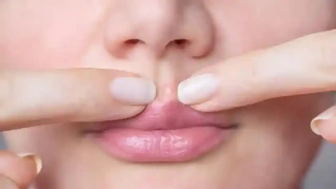 Alt Dudak Kenarında Sivilce Nedenleri, Önlemleri ve Etkili Tedavi Yöntemleri