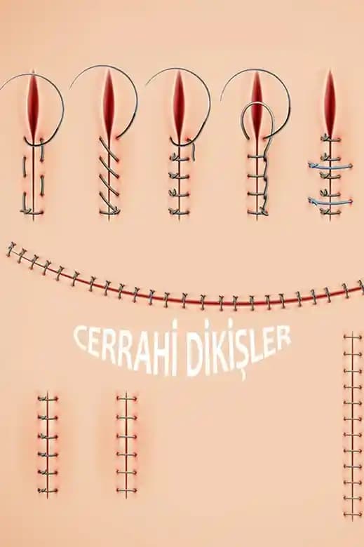 Ameliyattan Sonra Dikişlerin Alınma Zamanı ve Sağlıklı İyileşme Süreci Hakkında Bilgiler