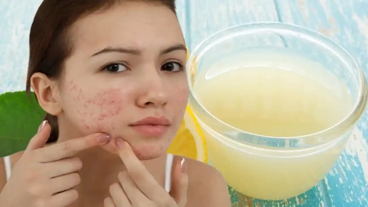 Asetonun Sivilce Üzerindeki Etkileri ve Dermatologların Sivilce Tedavisindeki Görüşleri