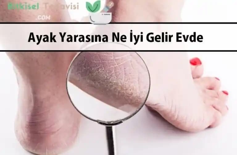 Ayak Altı Yarasına İyi Gelen Etkili Tedavi ve Bakım Yöntemleri Nelerdir?
