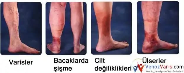 Bacaklarda Pullanma Nedenleri, Belirtileri ve Etkili Tedavi Yöntemleri