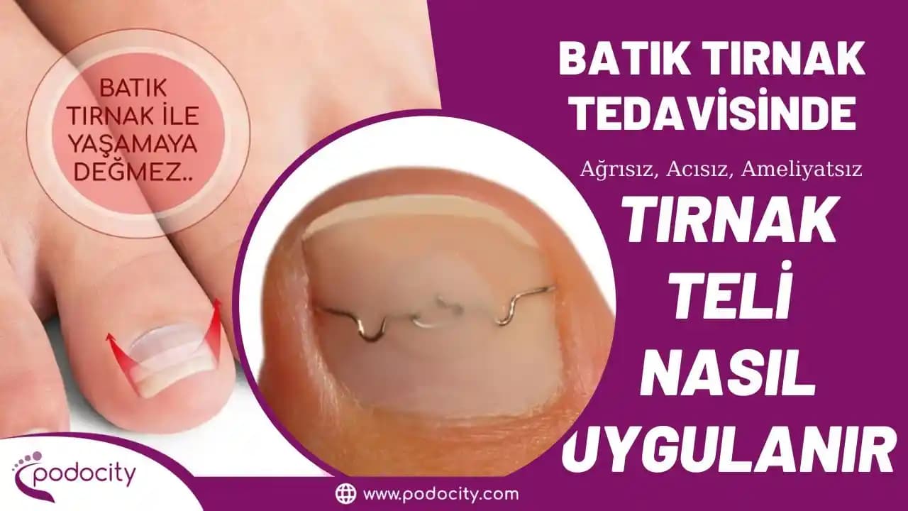 Batık Tırnak Teli ile Cerrahi Olmadan Etkili Batık Tırnak Tedavisi Yöntemleri