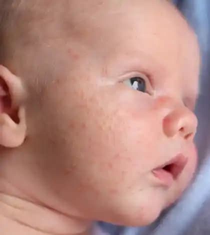 Bebek Aknesi Nedir? Yeni Doğan Bebeklerde Yaygın Cilt Probleminin Nedenleri ve Bakımı