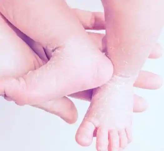 Bebeklerde Cilt Kuruluğu Nedenleri ve Etkili Bakım Yöntemleri Hakkında Rehber