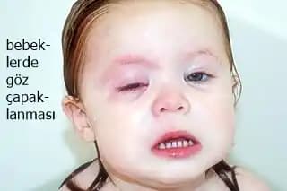 Bebeklerde Göz Kapağı Morarması: Nedenleri, Belirtileri ve Bakım Yöntemleri