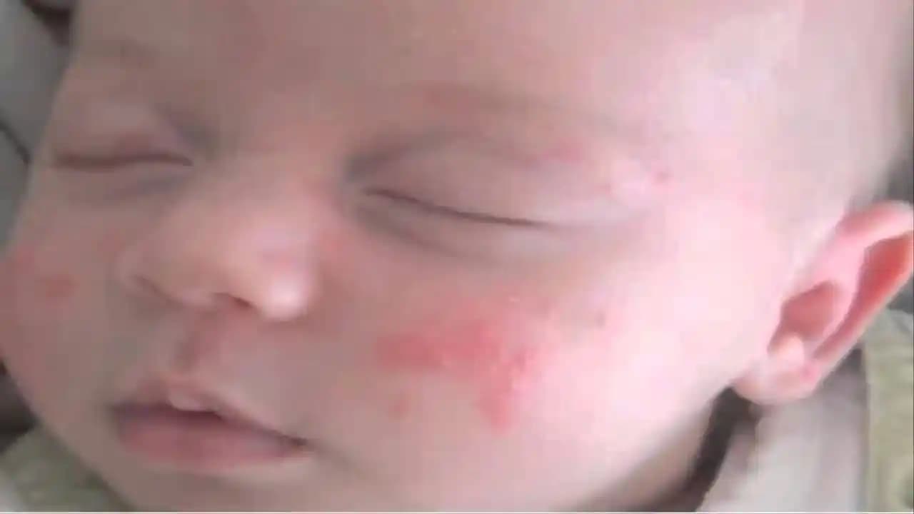 Bebeklerde Sivilce Gibi Kızarıklıkların Nedenleri, Tedavisi ve Bakım Önerileri