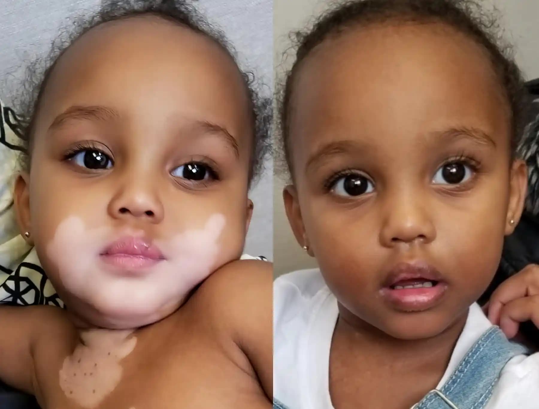 Bebeklerde Vitiligo: Tanı, Nedenler ve Etkili Tedavi Yöntemleri Rehberi