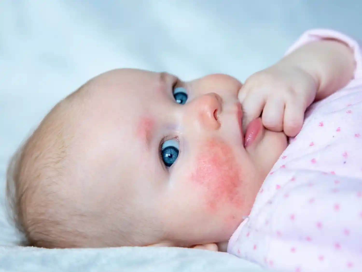 Bebeklerde Yüz Sivilceleri: Nedenleri, Bakımı ve Önleme Yöntemleri