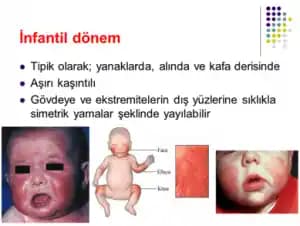 Bebeklerde Yüzde Kuruluk: Nedenleri, Belirtileri ve Etkili Bakım Yöntemleri