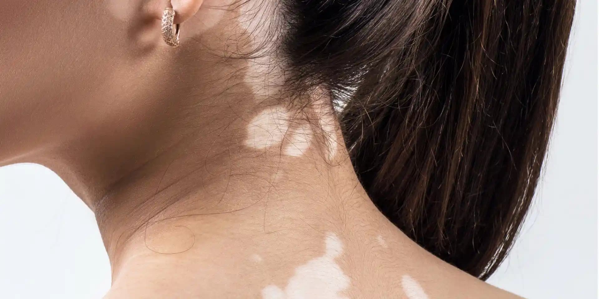 Beyaz Güneş Lekesi Nedir, Neden Oluşur ve Etkili Tedavi Yöntemleri