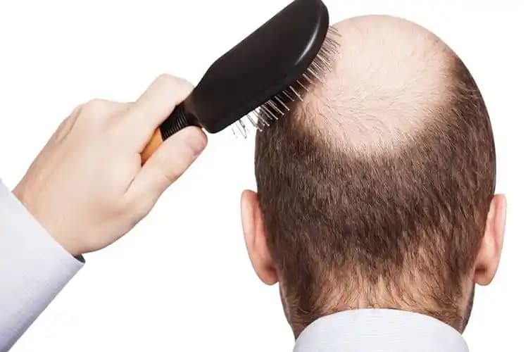 Bitlerin Saç Dökülmesine Etkisi: Doğru Bilinen Yanlışlar ve Gerçekler