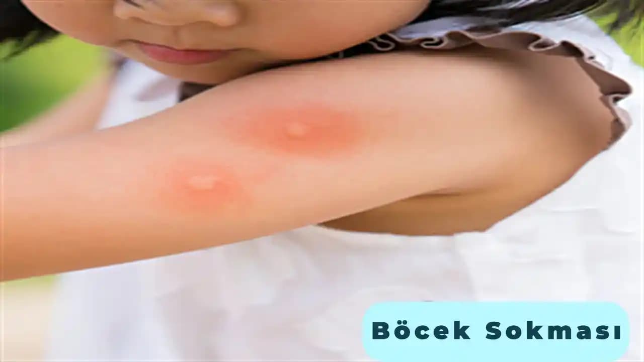 Böcek Isırması Kremi: Kaşıntı, Şişlik ve Kızarıklık İçin Etkili Çözüm