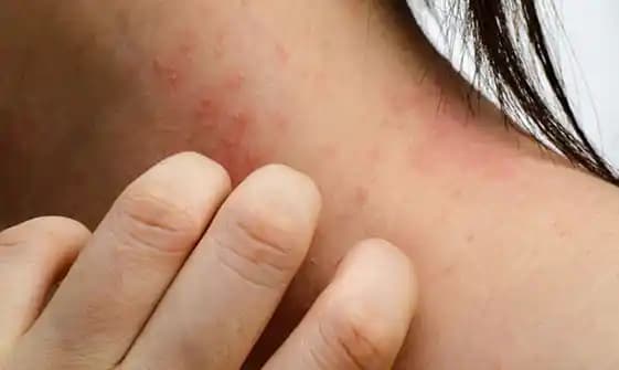 Boyunda Egzama Neden Olur? Nedenleri, Belirtileri ve Etkili Tedavi Yöntemleri