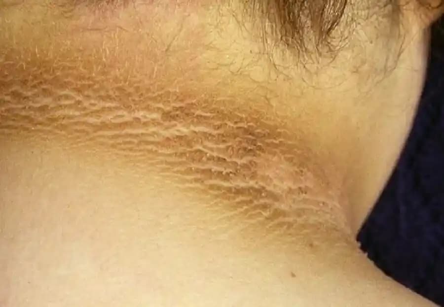 Boyundaki Siyah Lekelerin Nedenleri, Önleme Yolları ve Etkili Tedavi Seçenekleri