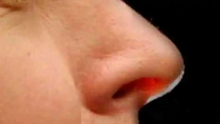 Burnun İçi Kuruluğu: Nedenleri, Belirtileri ve Etkili Tedavi Yöntemleri