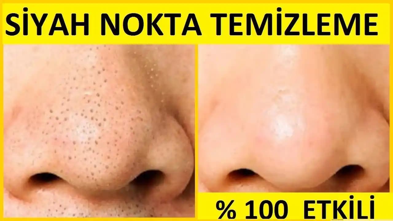 Burun Siyah Noktalarını Evde Temizlemenin Etkili Yöntemleri ve Cilt Bakım Önerileri