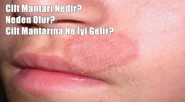 Cilt Mantarı Nedir ve Tedavisinde Doğal ve Kozmetik Yöntemlerin Önemi