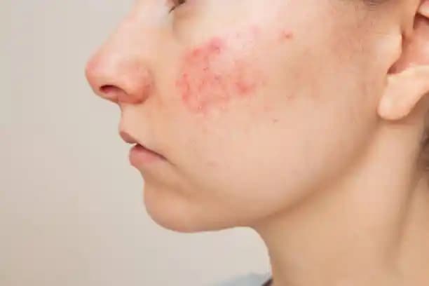 Cilt Tahrişi Ne Zaman Geçer? İyileşme Süreci ve Etkili Bakım Önerileri