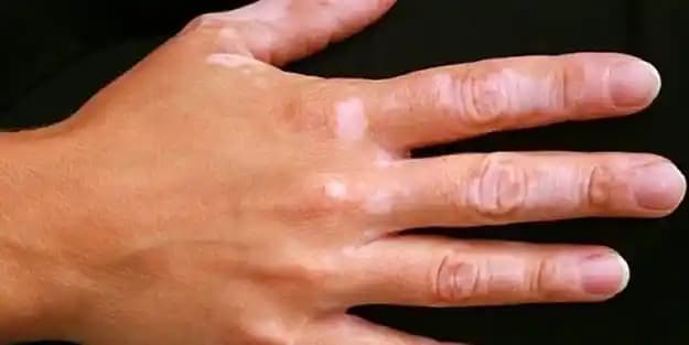 Ciltte Beyaz Lekeler: Nedenleri, Belirtileri ve Etkili Tedavi Yöntemleri