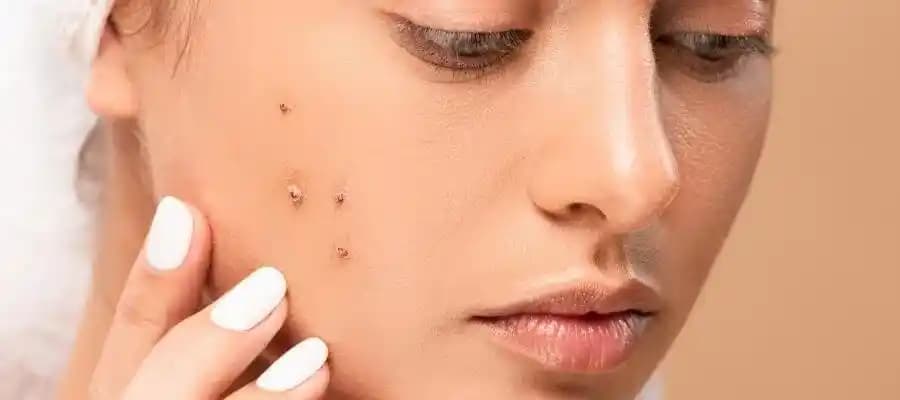 Ciltte Komedon Nedir? Türleri, Nedenleri ve Etkili Korunma Yöntemleri
