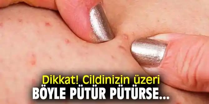 Ciltte Pütürcüklerin Nedenleri, Türleri ve Etkili Bakım Yöntemleri