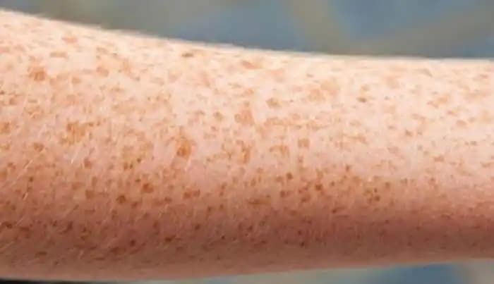 Ciltte Sarı Lekeler: Nedenleri, Önleme Yöntemleri ve Etkili Tedavi Seçenekleri