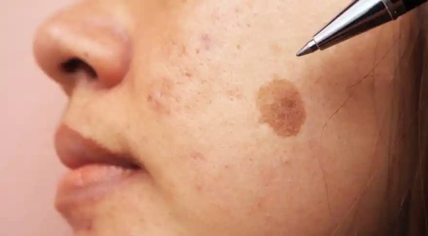 Ciltteki Kahverengi Lekeler: Nedenleri, Önlenmesi ve Etkili Tedavi Yöntemleri