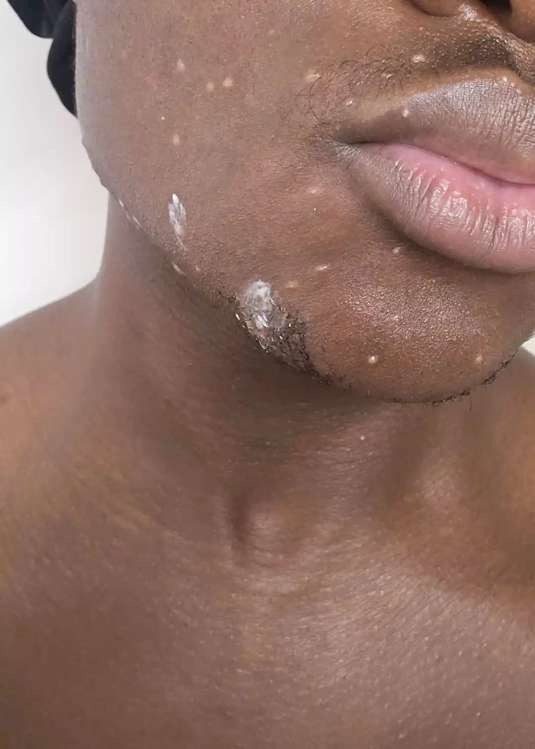 Akne Sonrası İnatçı Hipopigmentasyon: Nedenleri, Belirtileri ve Etkili Tedavi Yöntemleri