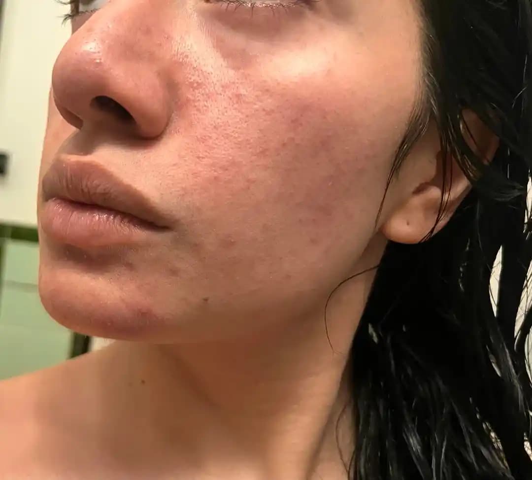 Cilt Dokusu İyileştirme Yöntemleri: Gözenekler, Siyah ve Beyaz Noktalar Üzerine Bilimsel Yaklaşımlar