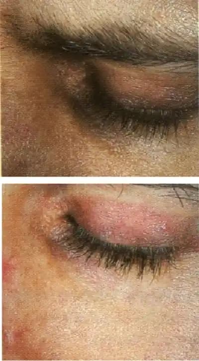 Göz Altı Morlukları ve Dudak Kuruluğuna Karşı Etkili Bakım ve Tedavi Yöntemleri