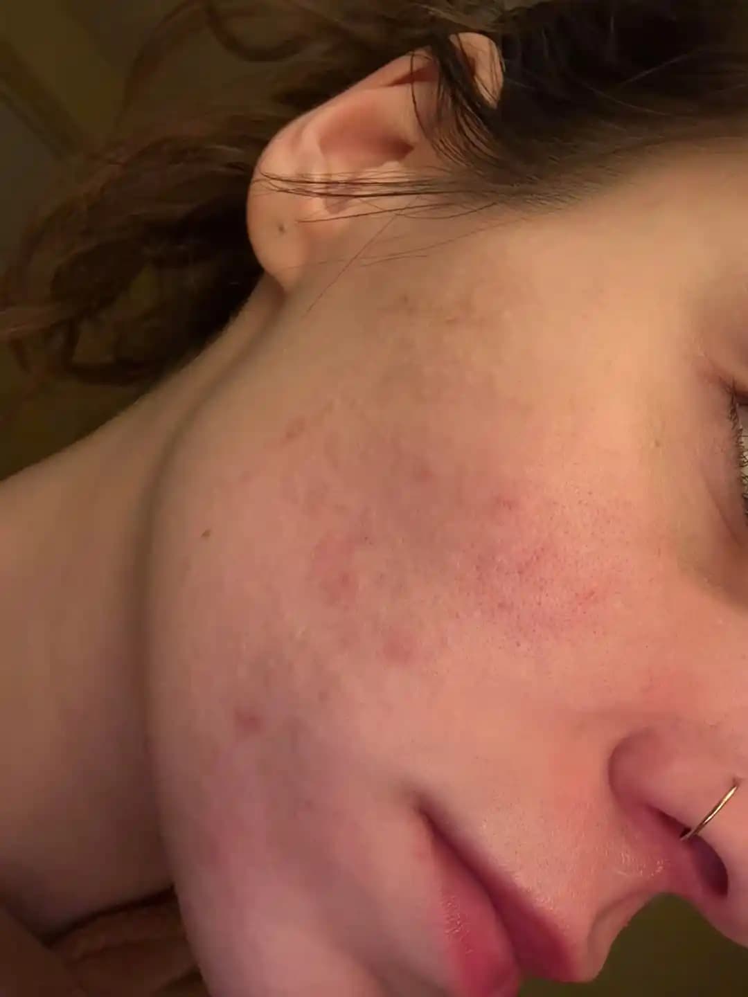 Kapalı Komedon ve Cilt Dokusu Problemlerinde Etkili Tedavi Yöntemleri ve Yaklaşımlar