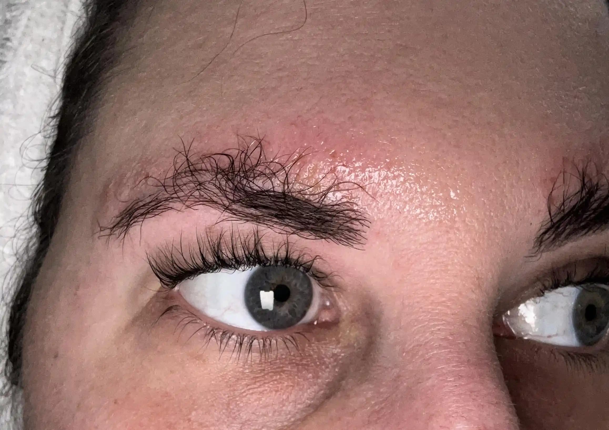 Kaş Laminasyonu Sonrası Kimyasal Yanık ve Hasar: Nedenler, Belirtiler ve Tedavi Yöntemleri