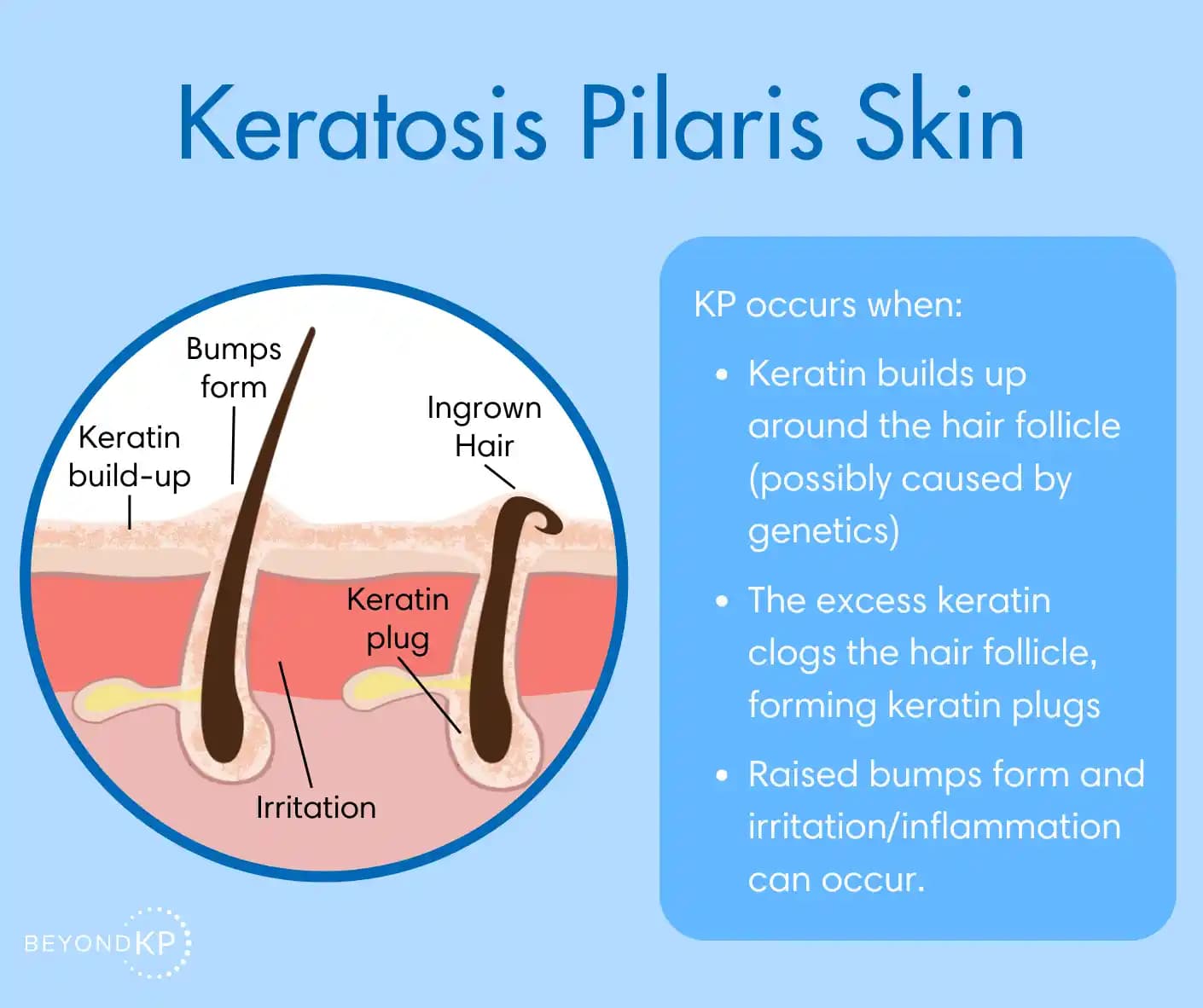 Keratosis Pilaris Nedenleri, Tedavi Yöntemleri ve Yönetimi Hakkında Detaylı Bilgi