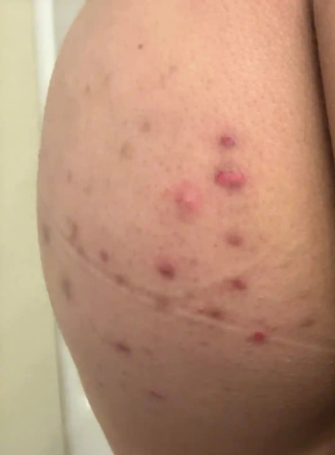 Popo Bölgesinde Akne ve Cilt Problemleri: Nedenleri, Belirtileri ve Etkili Tedavi Yöntemleri