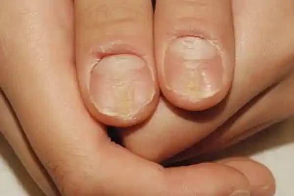 Sert Jel Tırnaklarda Yeşil Bakteriyel Enfeksiyonun Nedenleri ve Tedavi Yöntemleri