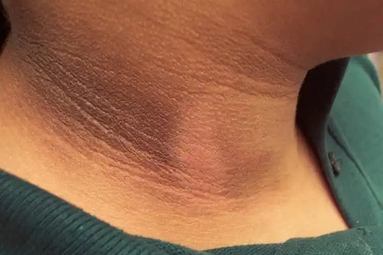 Deri Kararmasının Nedenleri, Önlenmesi ve Etkili Tedavi Yöntemleri Hakkında Bilgi