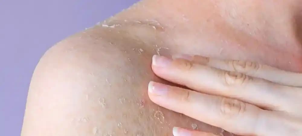 Deri Yüzülmesine İyi Gelen Etkili Çözümler ve Doğru Cilt Bakım Önerileri