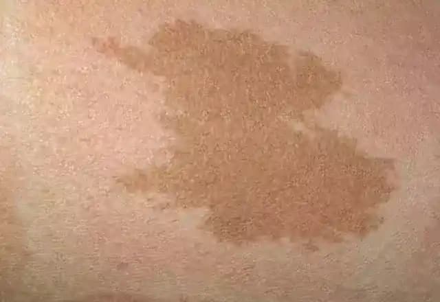 Deride Kahverengi Lekeler: Nedenleri, Önlenmesi ve Etkili Tedavi Yöntemleri