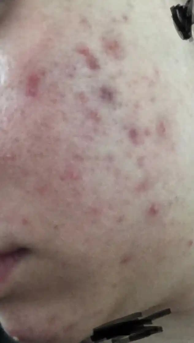 Derinin Altında Sivilce: Nedenleri, Etkili Tedavi Yöntemleri ve Bakım Önerileri