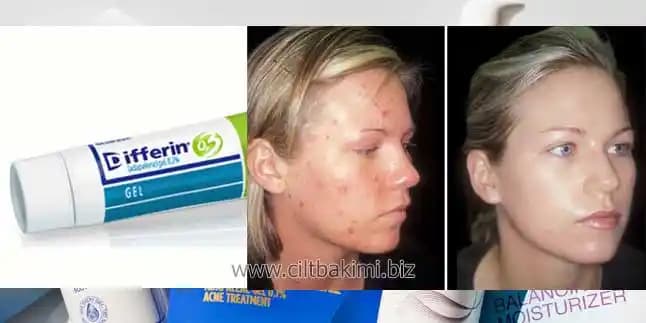 Differin Jel Nedir ve Akne Tedavisinde Nasıl Etkili Bir Çözüm Sağlar?