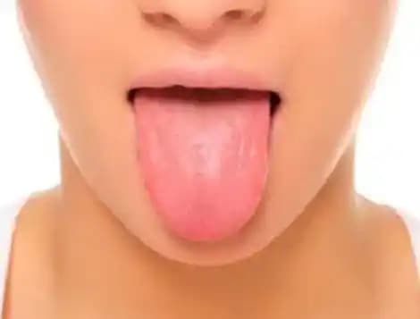 Dil Altında Sivilce Gibi Şişliklerin Nedenleri, Tedavisi ve Bakım Önerileri