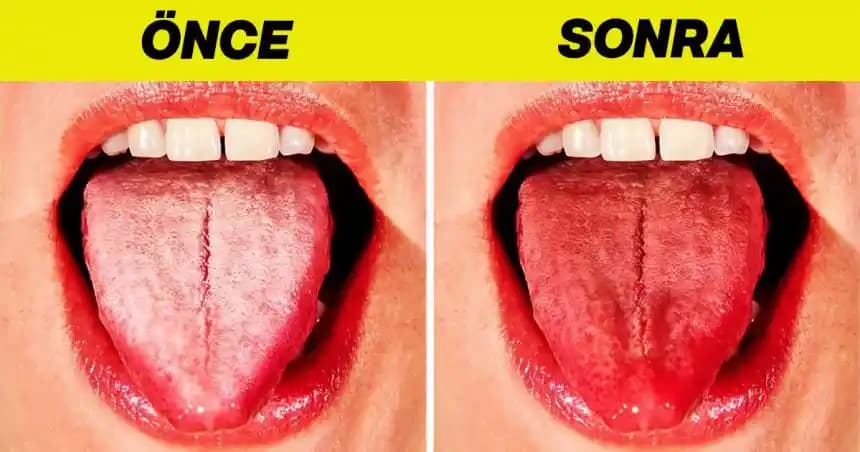 Dil Beyazlamasının Nedenleri ve Önlenmesi: Sağlıklı Bir Dil İçin Önemli Bilgiler