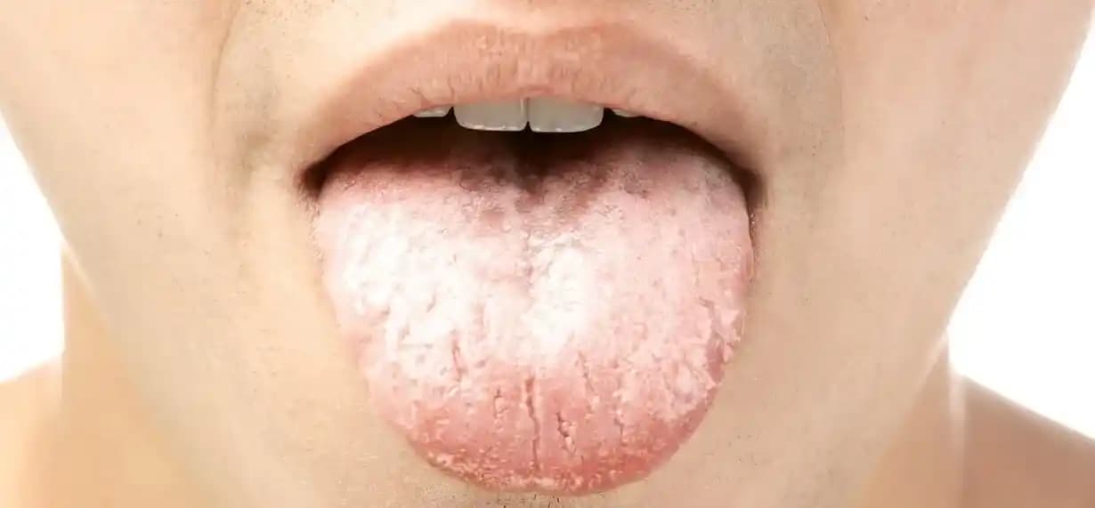 Dil Beyazlığı: Nedenleri, Belirtileri ve Etkili Bakım Yöntemleri