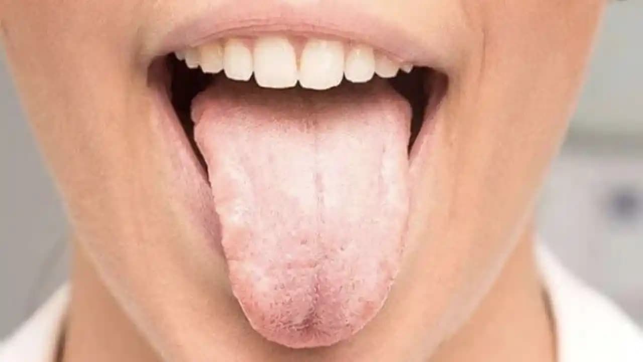 Dilde Beyazlık Nedenleri, Etkileri ve Çözüm Yolları Hakkında Kapsamlı Rehber