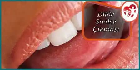 Dilde Sivilce Çıkmasının Nedenleri, Belirtileri ve Etkili Tedavi Yöntemleri