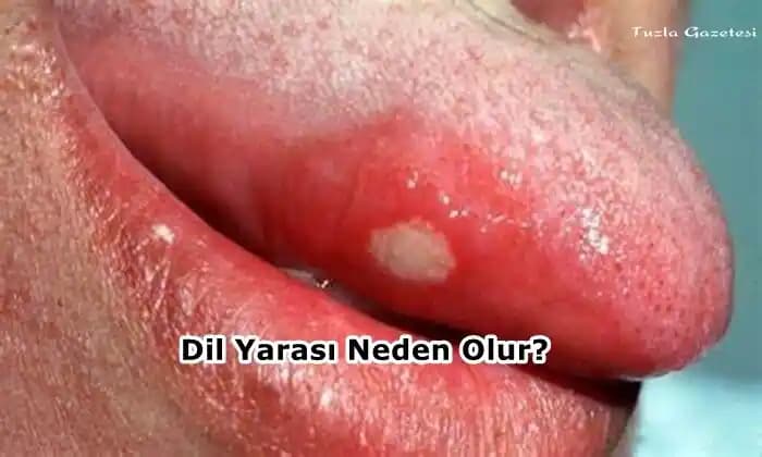 Dildeki Yarıkların Nedenleri, Belirtileri ve Korunma Yöntemleri Hakkında Bilgi