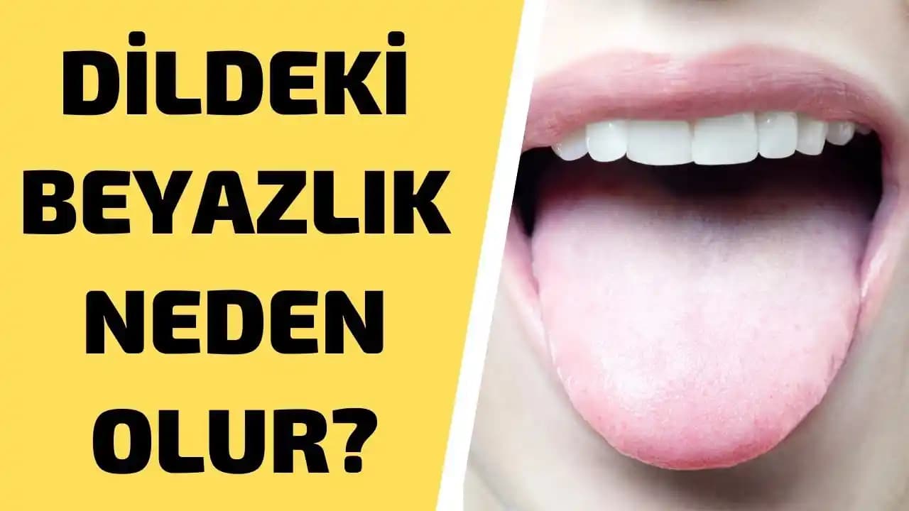 Dilin Üstündeki Beyazlık: Nedenleri, Tedavi Yöntemleri ve Kişisel Bakım Önerileri