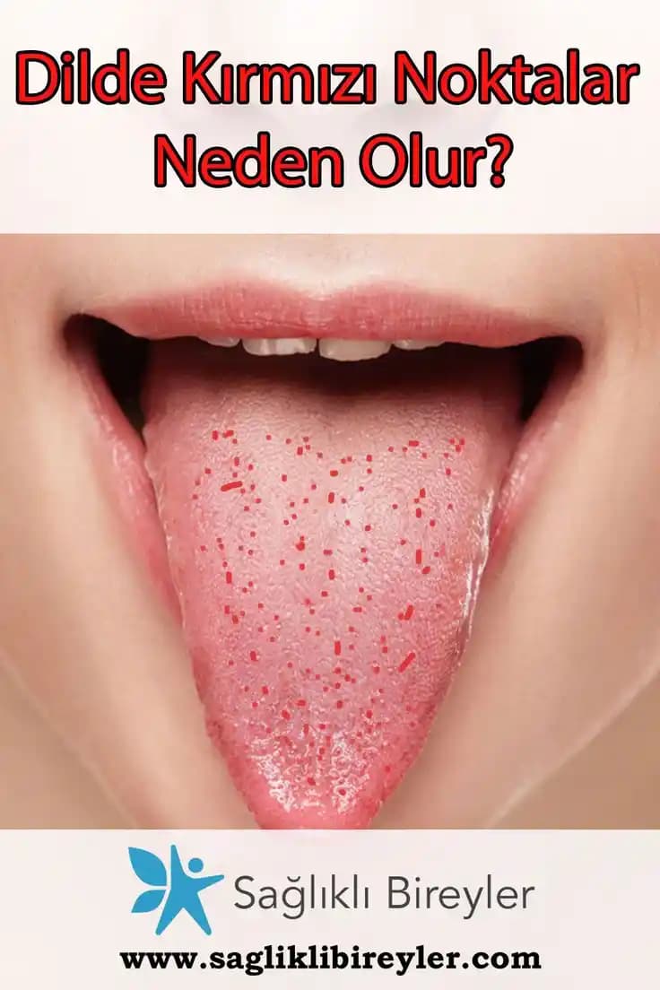 Dilin Üzerindeki Kırmızı Noktaların Nedenleri, Belirtileri ve Etkili Tedavi Yöntemleri