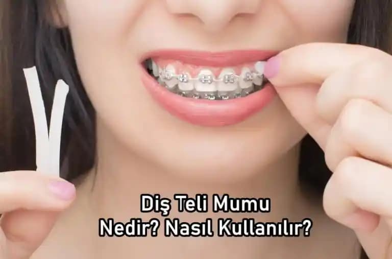 Diş Teli Mumu Nedir ve Ortodontik Tedavide Konforu Nasıl Sağlar?