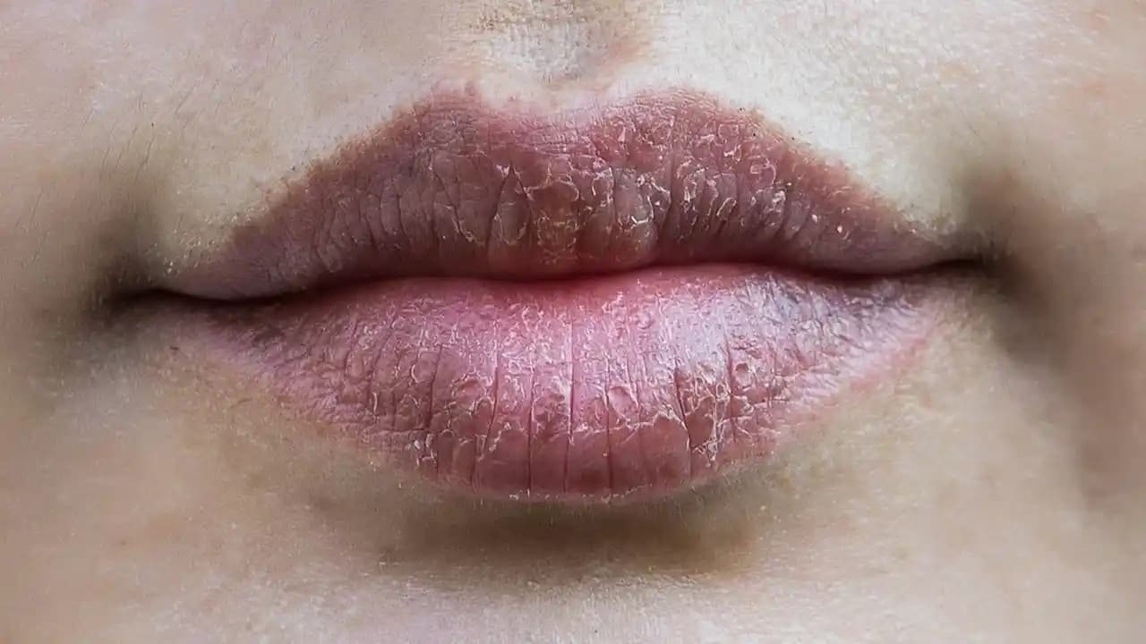 Dudak Kenarı Kuruluğu: Nedenleri, Belirtileri ve Etkili Bakım Yöntemleri